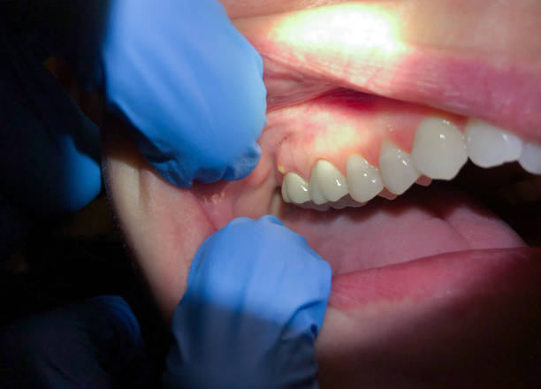 Best Lost Filling or Crown Replacement in Earlysville, VA