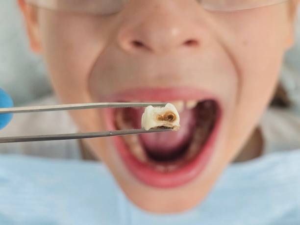 Best Emergency Wisdom Tooth Extraction in Earlysville, VA